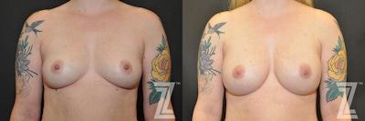 Breast Reconstruction Before & After Gallery - Patient 132886770 - Image 1