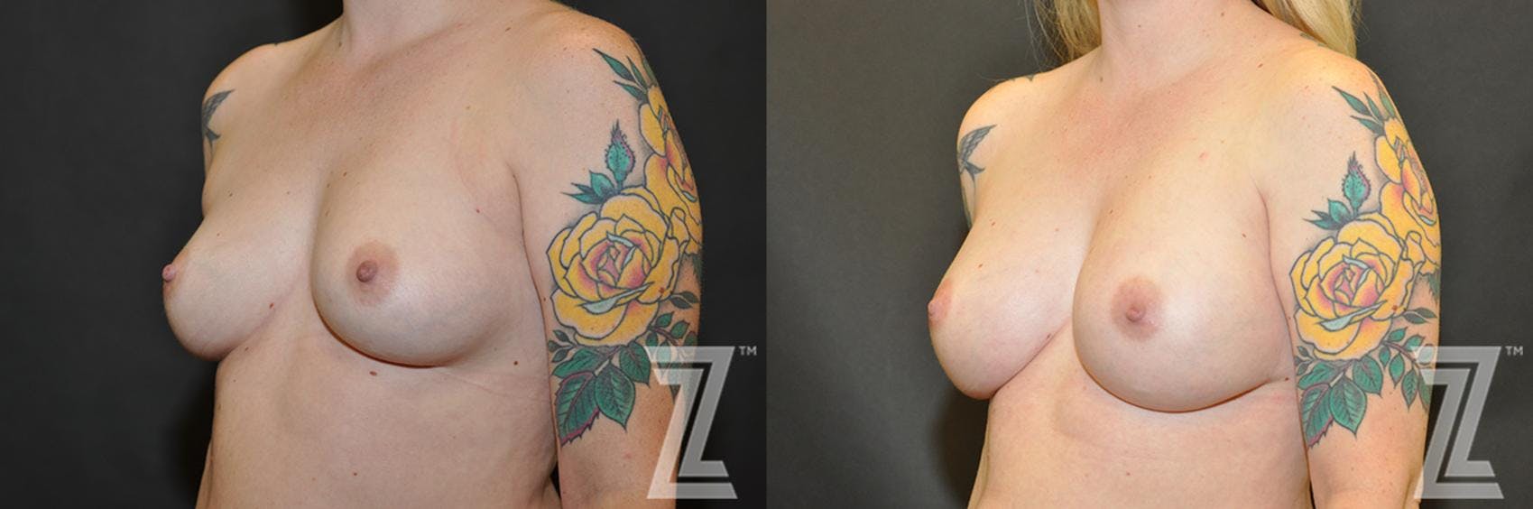 Breast Reconstruction Before & After Gallery - Patient 132886770 - Image 2