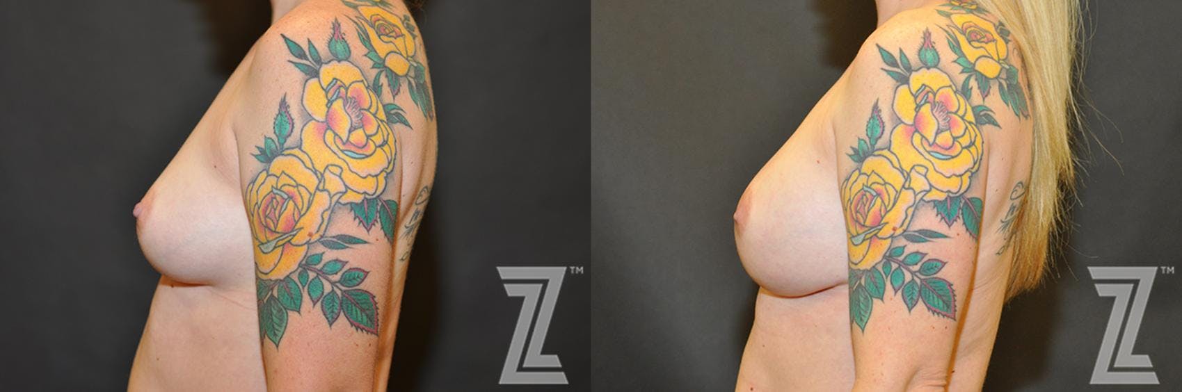 Breast Reconstruction Before & After Gallery - Patient 132886770 - Image 3