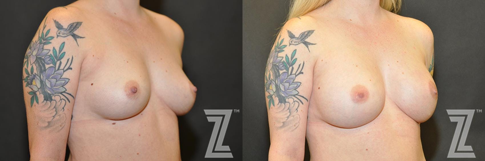 Breast Reconstruction Before & After Gallery - Patient 132886770 - Image 4