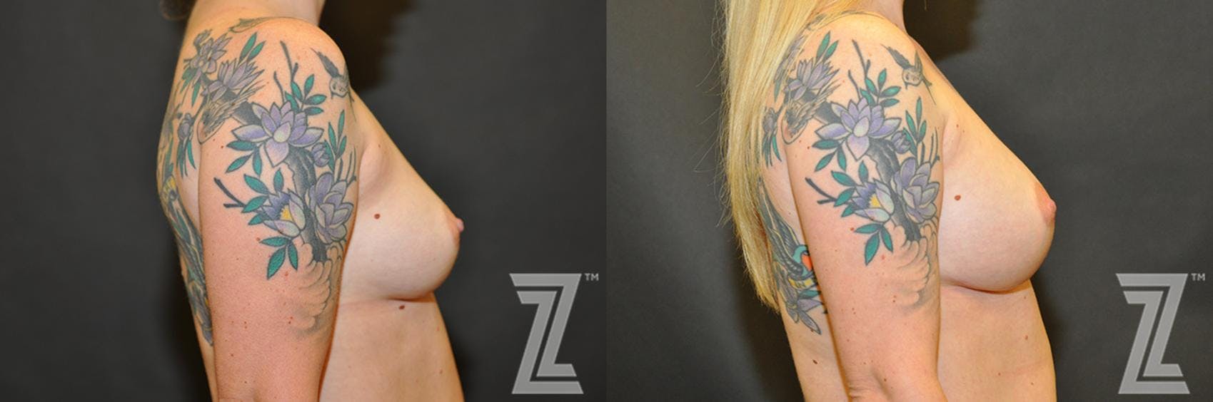 Breast Reconstruction Before & After Gallery - Patient 132886770 - Image 5