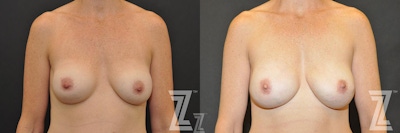 Breast Reconstruction Before & After Gallery - Patient 132886773 - Image 1