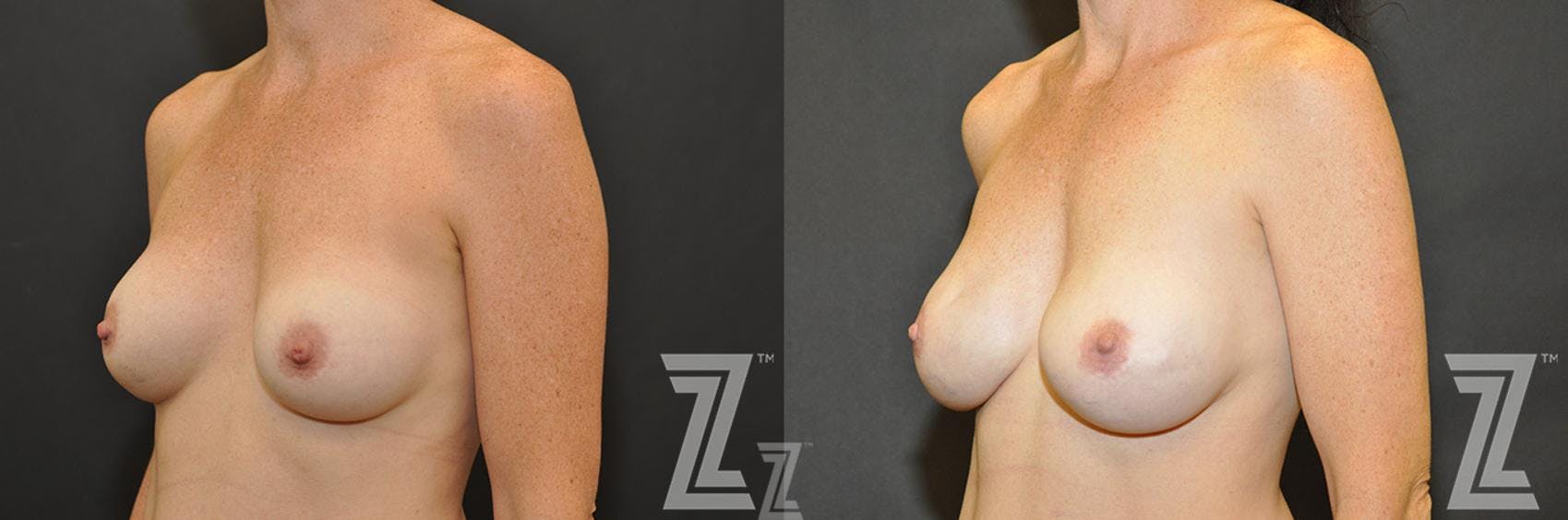 Breast Reconstruction Before & After Gallery - Patient 132886773 - Image 2