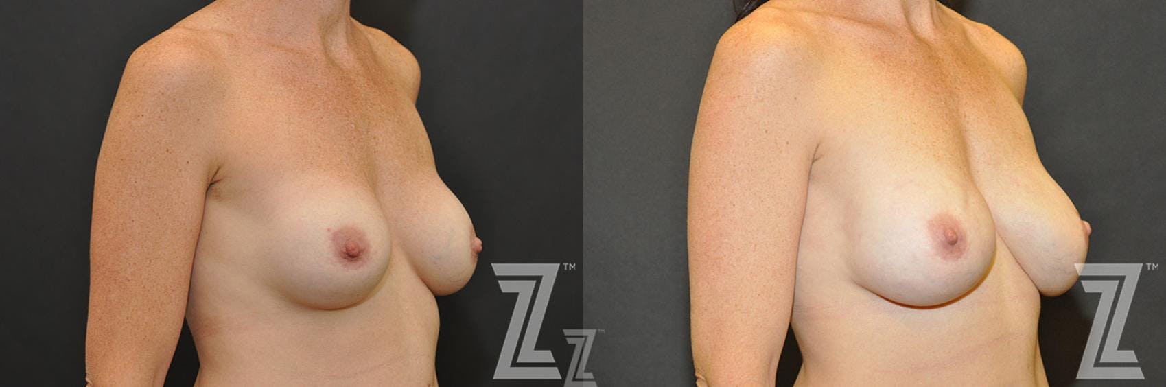 Breast Reconstruction Before & After Gallery - Patient 132886773 - Image 4