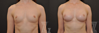 Breast Reconstruction Before & After Gallery - Patient 132886774 - Image 1