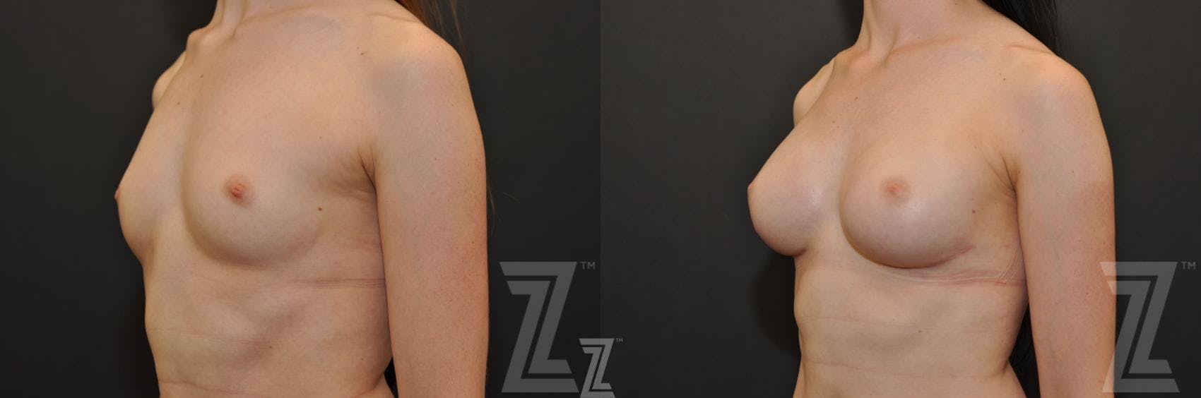 Breast Reconstruction Before & After Gallery - Patient 132886774 - Image 2