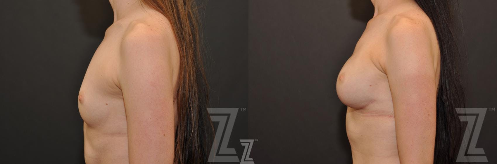 Breast Reconstruction Before & After Gallery - Patient 132886774 - Image 3