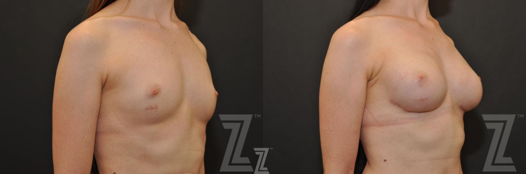 Breast Reconstruction Before & After Gallery - Patient 132886774 - Image 4