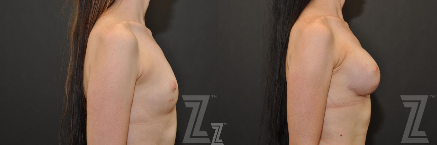 Breast Reconstruction Before & After Gallery - Patient 132886774 - Image 5