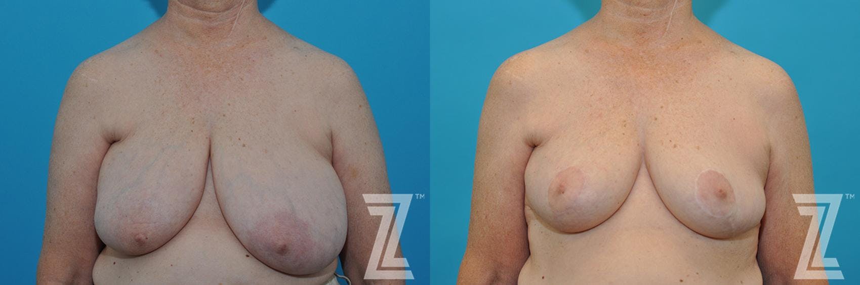 Correction of Breast Asymmetry Before & After Gallery - Patient 132886776 - Image 1