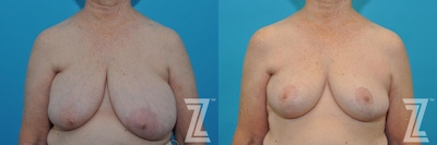 Correction of Breast Asymmetry Before & After Gallery - Patient 132886776 - Image 1