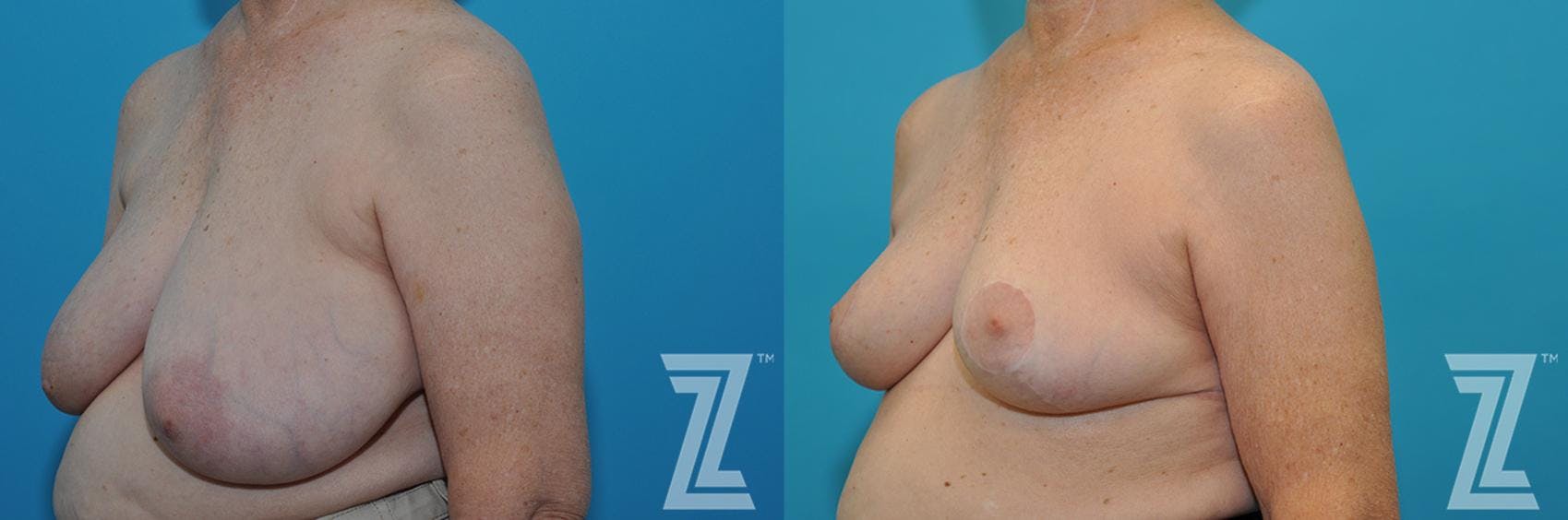 Correction of Breast Asymmetry Before & After Gallery - Patient 132886776 - Image 2