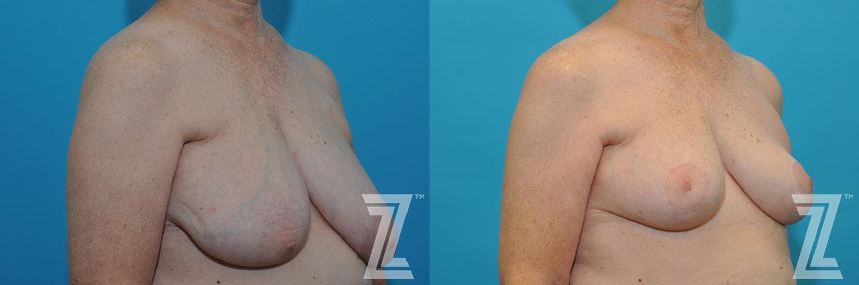 Correction of Breast Asymmetry Before & After Gallery - Patient 132886776 - Image 4