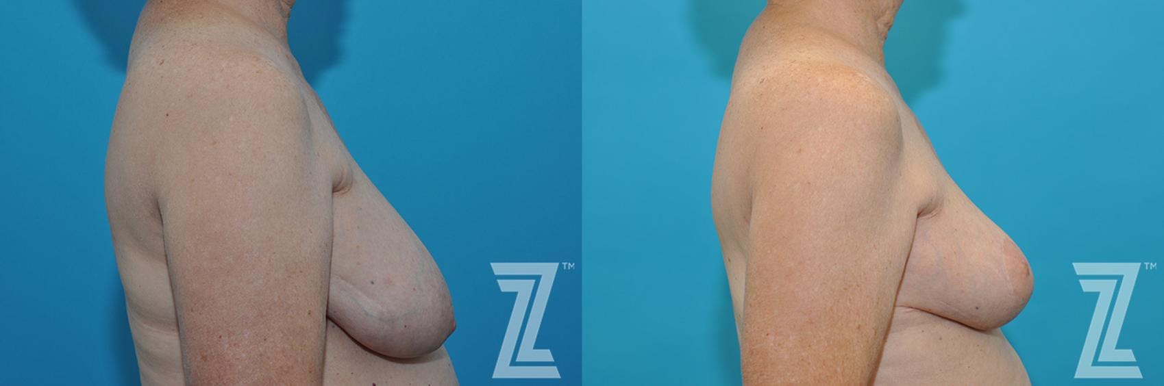 Correction of Breast Asymmetry Before & After Gallery - Patient 132886776 - Image 5