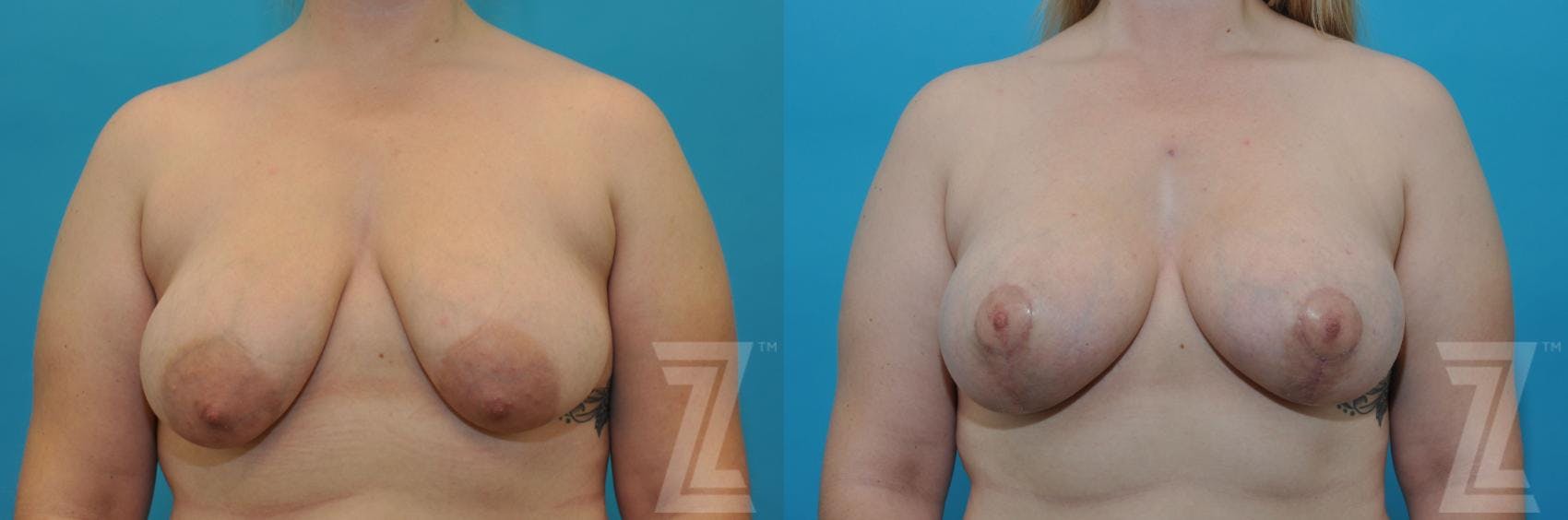 Correction of Breast Asymmetry Before & After Gallery - Patient 132886777 - Image 1
