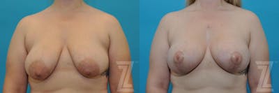 Austin Correction of Breast Asymmetry Before & After Gallery - Patient 132886777 - Image 1 - The Piazza Center