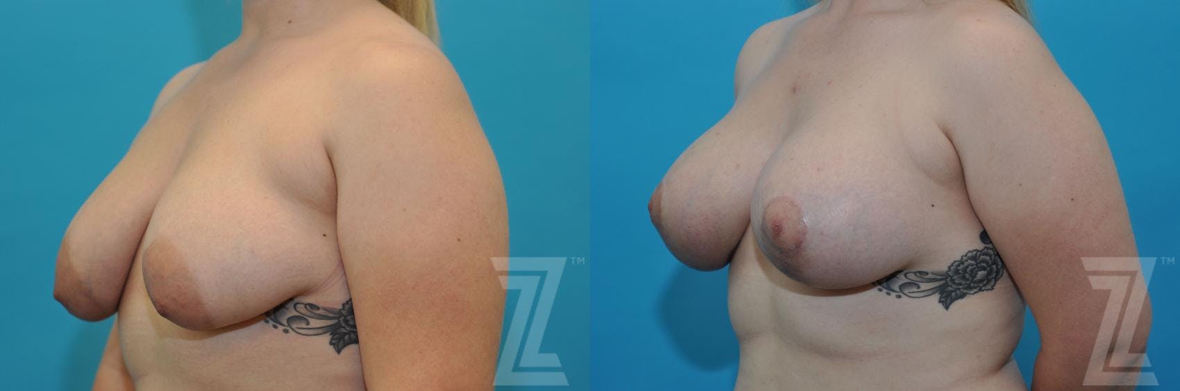 Correction of Breast Asymmetry Before & After Gallery - Patient 132886777 - Image 2