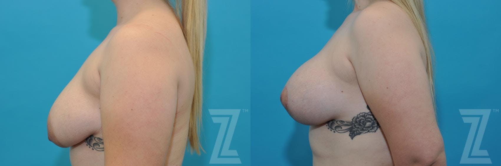Correction of Breast Asymmetry Before & After Gallery - Patient 132886777 - Image 3