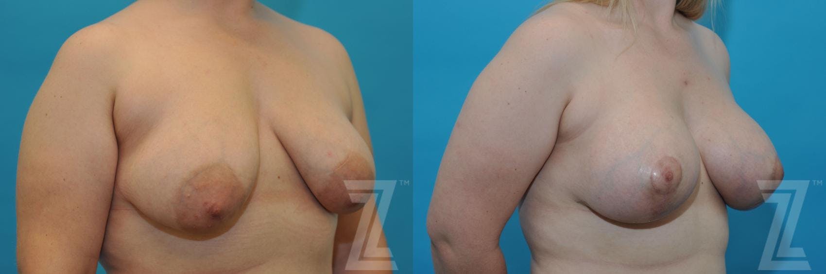 Correction of Breast Asymmetry Before & After Gallery - Patient 132886777 - Image 4