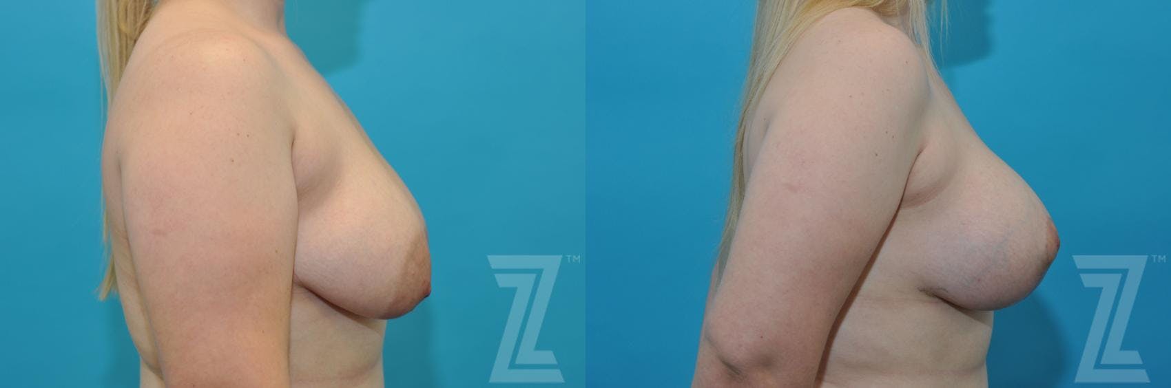 Correction of Breast Asymmetry Before & After Gallery - Patient 132886777 - Image 5