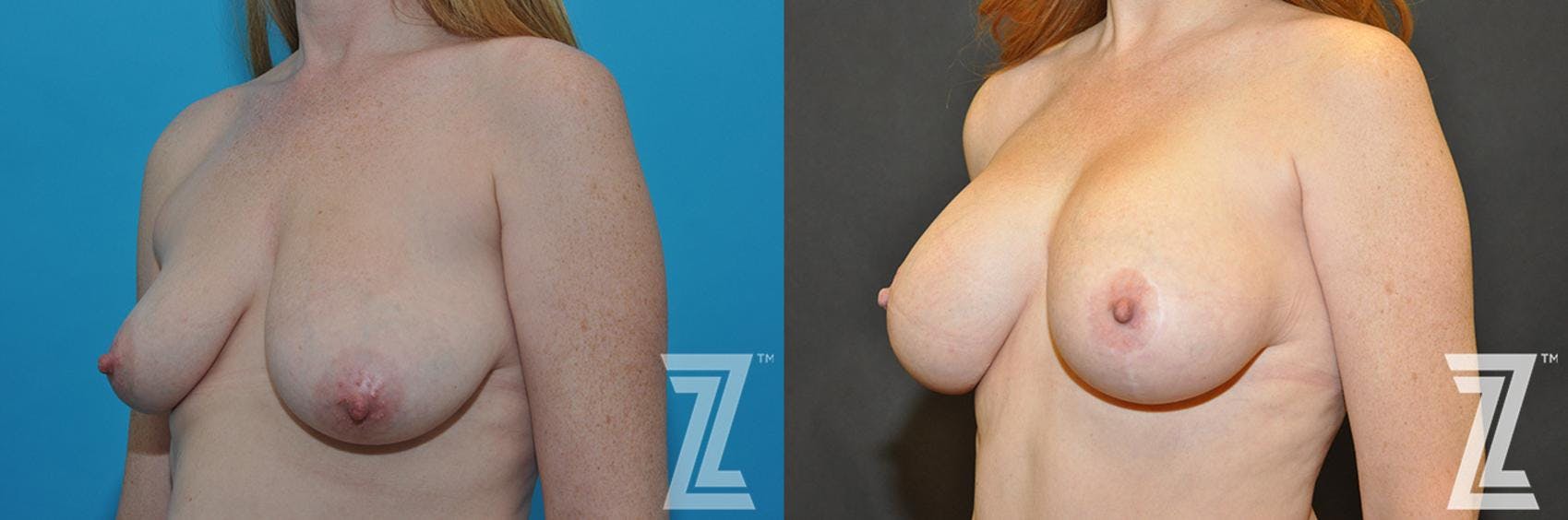 Correction of Breast Asymmetry Before & After Gallery - Patient 132886778 - Image 2