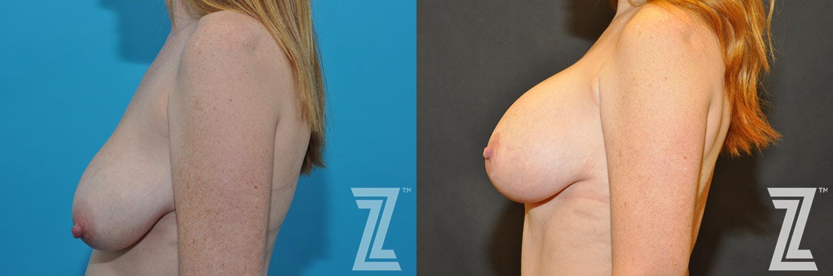 Correction of Breast Asymmetry Before & After Gallery - Patient 132886778 - Image 3