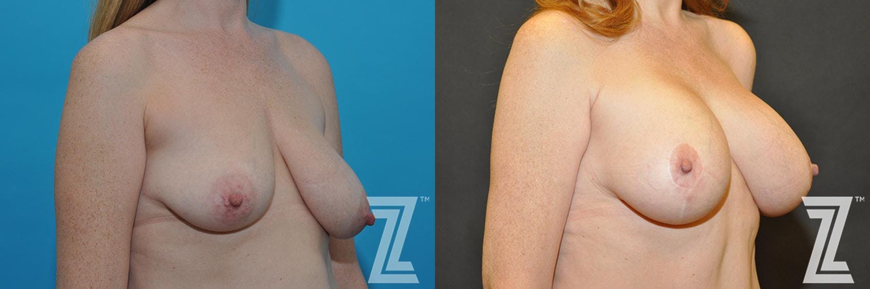 Correction of Breast Asymmetry Before & After Gallery - Patient 132886778 - Image 4