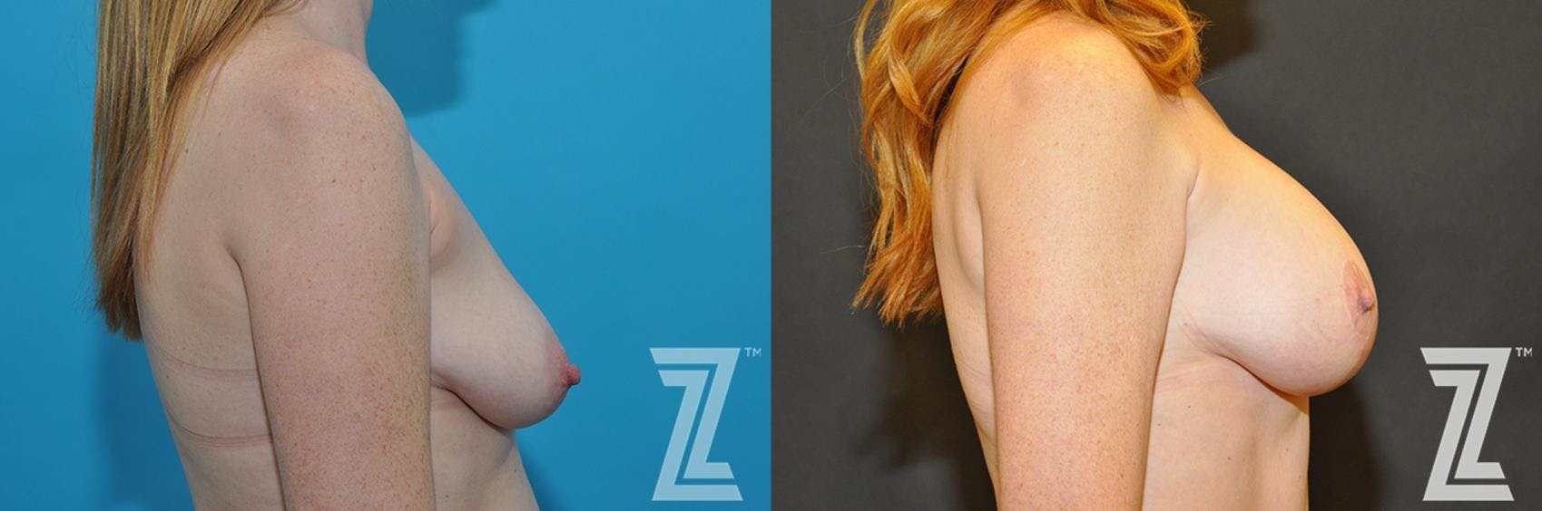 Correction of Breast Asymmetry Before & After Gallery - Patient 132886778 - Image 5