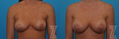 Correction of Breast Asymmetry Before & After Gallery - Patient 132886779 - Image 1