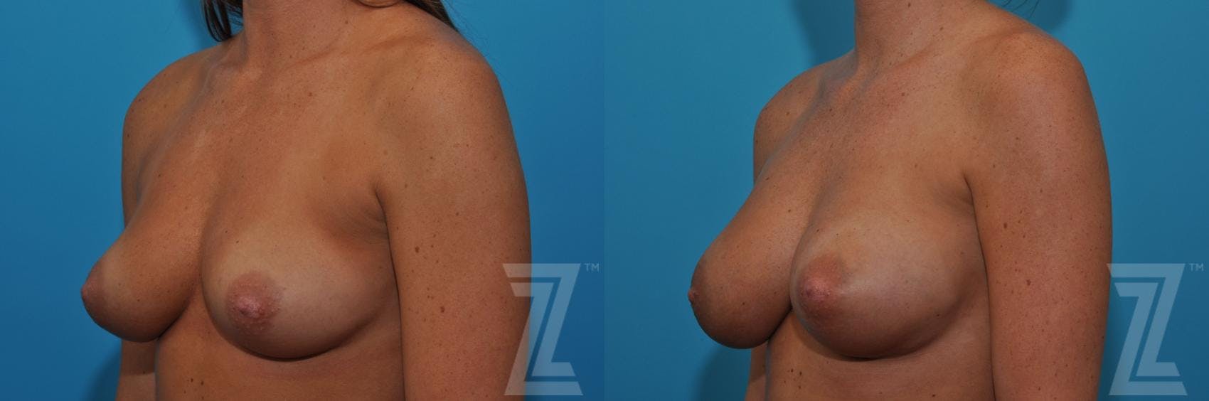 Correction of Breast Asymmetry Before & After Gallery - Patient 132886779 - Image 2