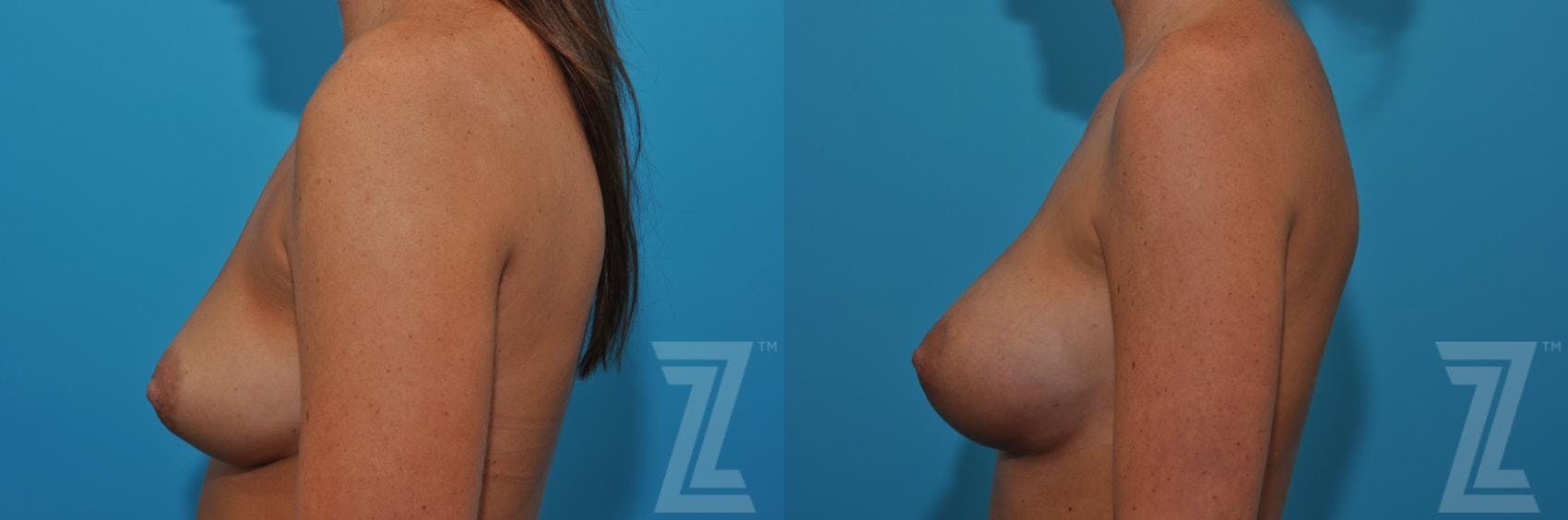 Correction of Breast Asymmetry Before & After Gallery - Patient 132886779 - Image 3