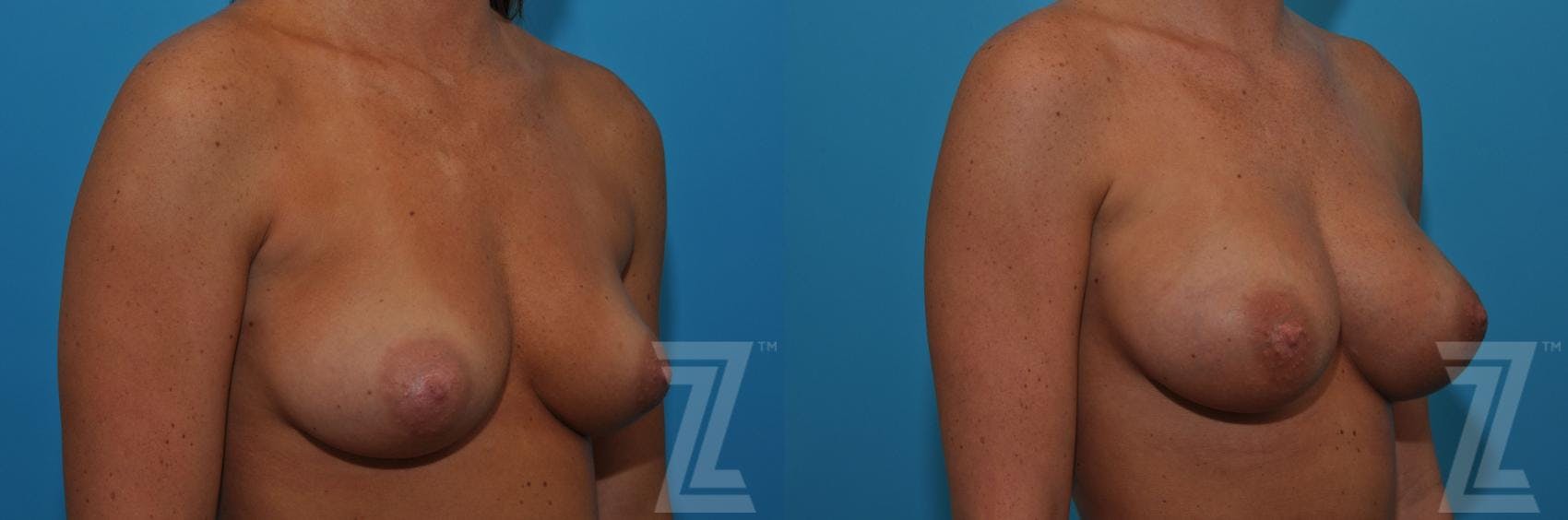 Correction of Breast Asymmetry Before & After Gallery - Patient 132886779 - Image 4