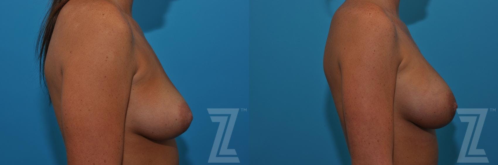 Correction of Breast Asymmetry Before & After Gallery - Patient 132886779 - Image 5