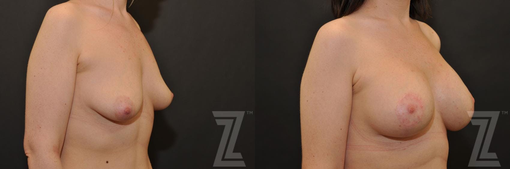 Correction of Breast Asymmetry Before & After Gallery - Patient 132886780 - Image 4