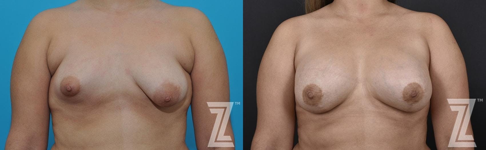 Correction of Breast Asymmetry Before & After Gallery - Patient 132886781 - Image 1