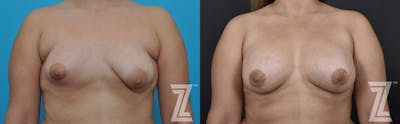 Austin Correction of Breast Asymmetry Before & After Gallery - Patient 132886781 - Image 1 - The Piazza Center