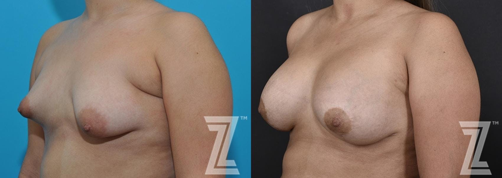 Correction of Breast Asymmetry Before & After Gallery - Patient 132886781 - Image 2