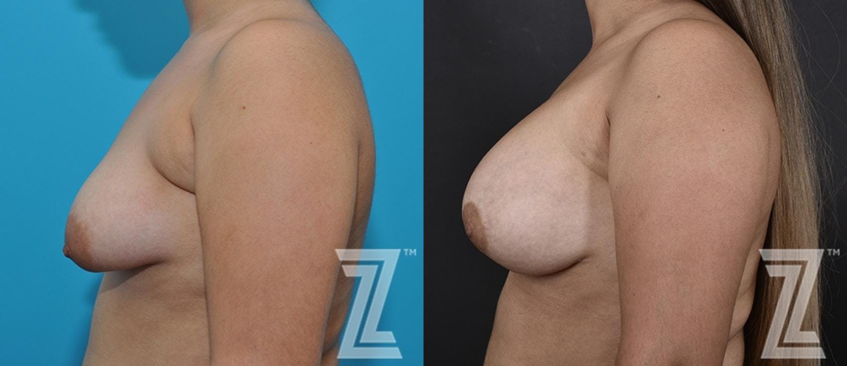 Correction of Breast Asymmetry Before & After Gallery - Patient 132886781 - Image 3