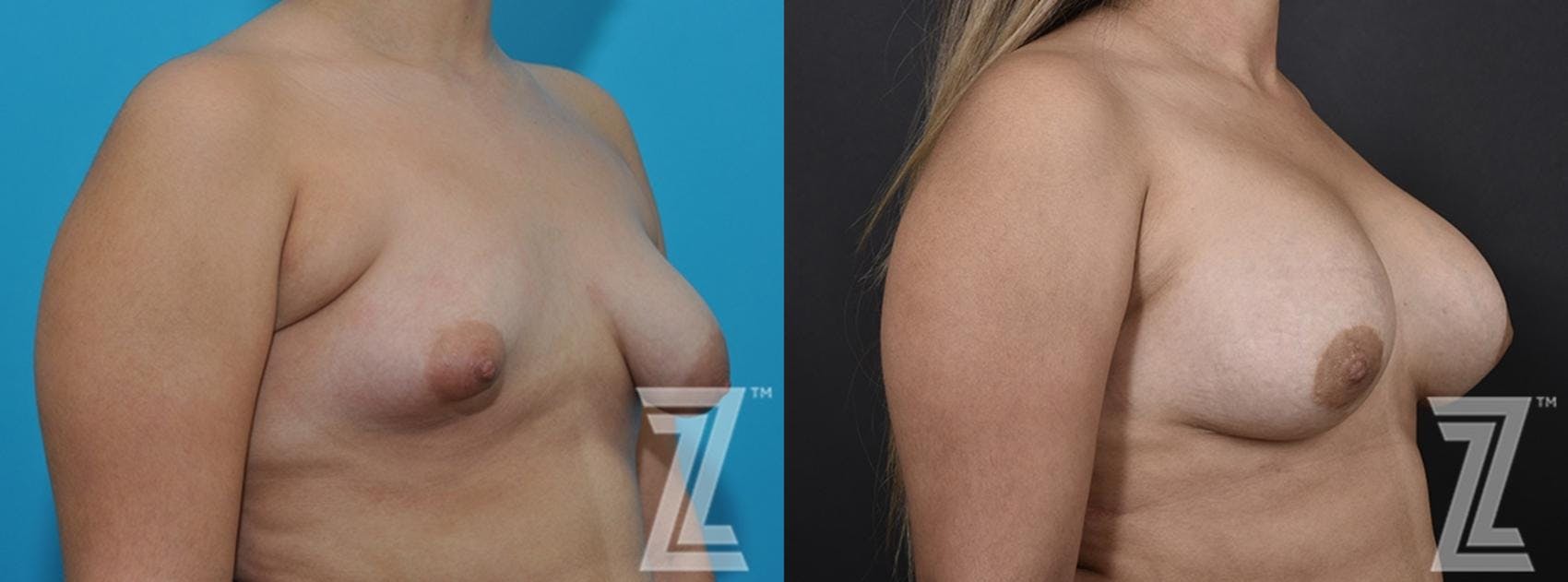Correction of Breast Asymmetry Before & After Gallery - Patient 132886781 - Image 4