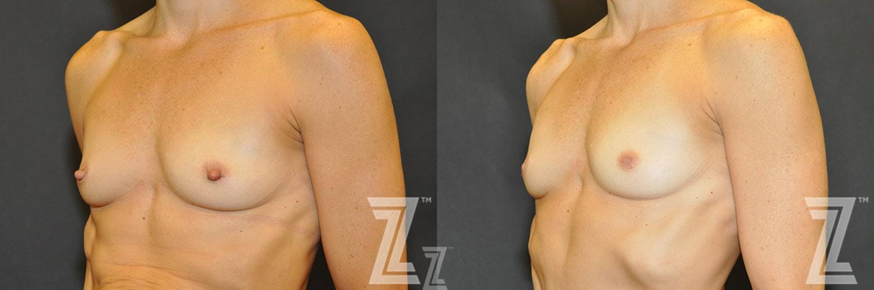 Nipple Reduction Before & After Gallery - Patient 132886785 - Image 1