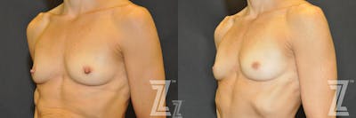 Austin Nipple Reduction Before & After Gallery - Patient 132886785 - Image 1 - The Piazza Center