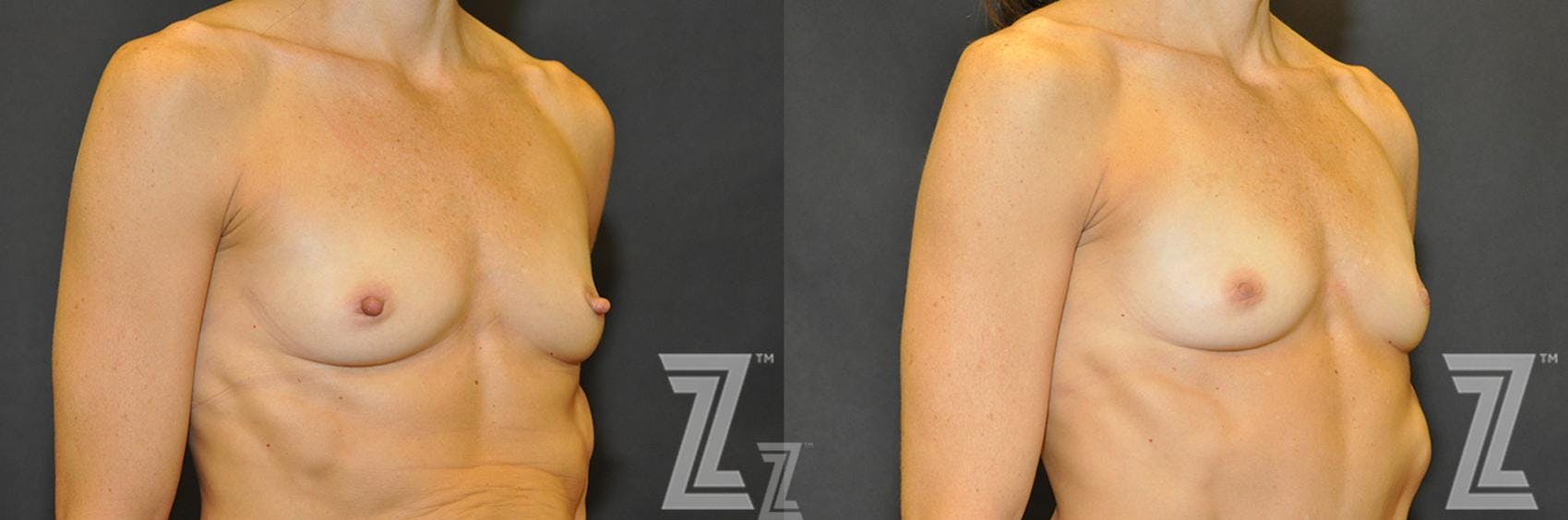 Nipple Reduction Before & After Gallery - Patient 132886785 - Image 2
