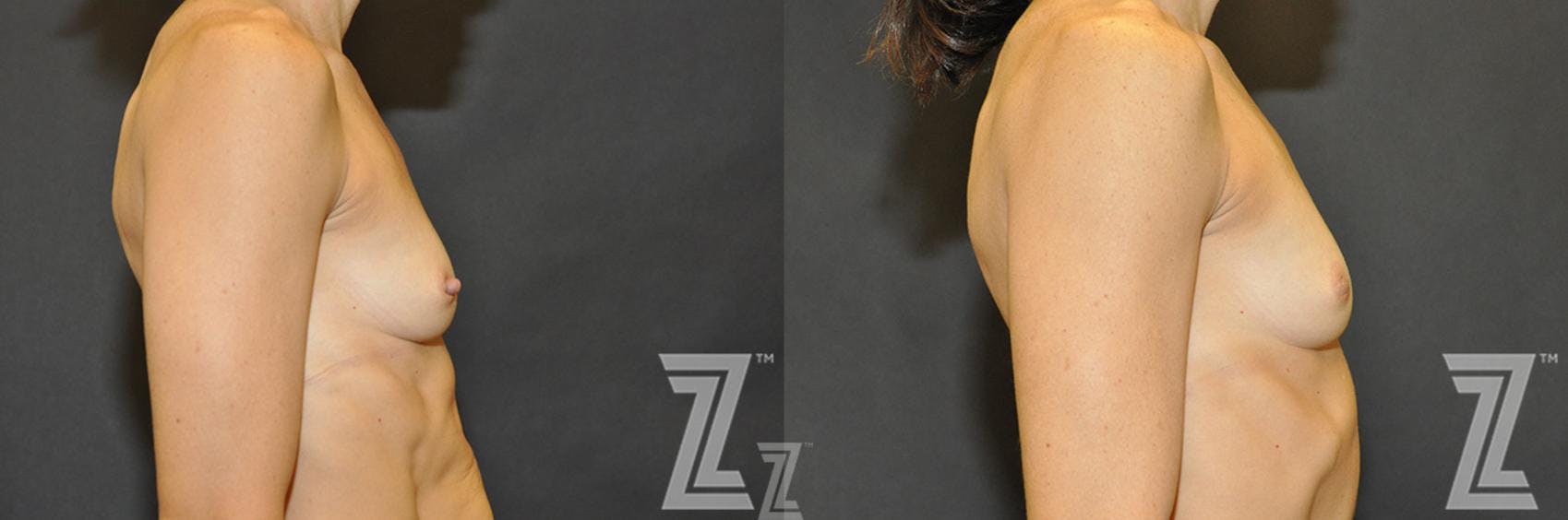 Nipple Reduction Before & After Gallery - Patient 132886785 - Image 4