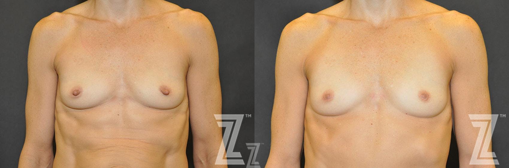 Nipple Reduction Before & After Gallery - Patient 132886785 - Image 5