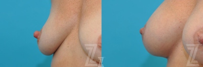 Nipple Reduction Before & After Gallery - Patient 132886786 - Image 1