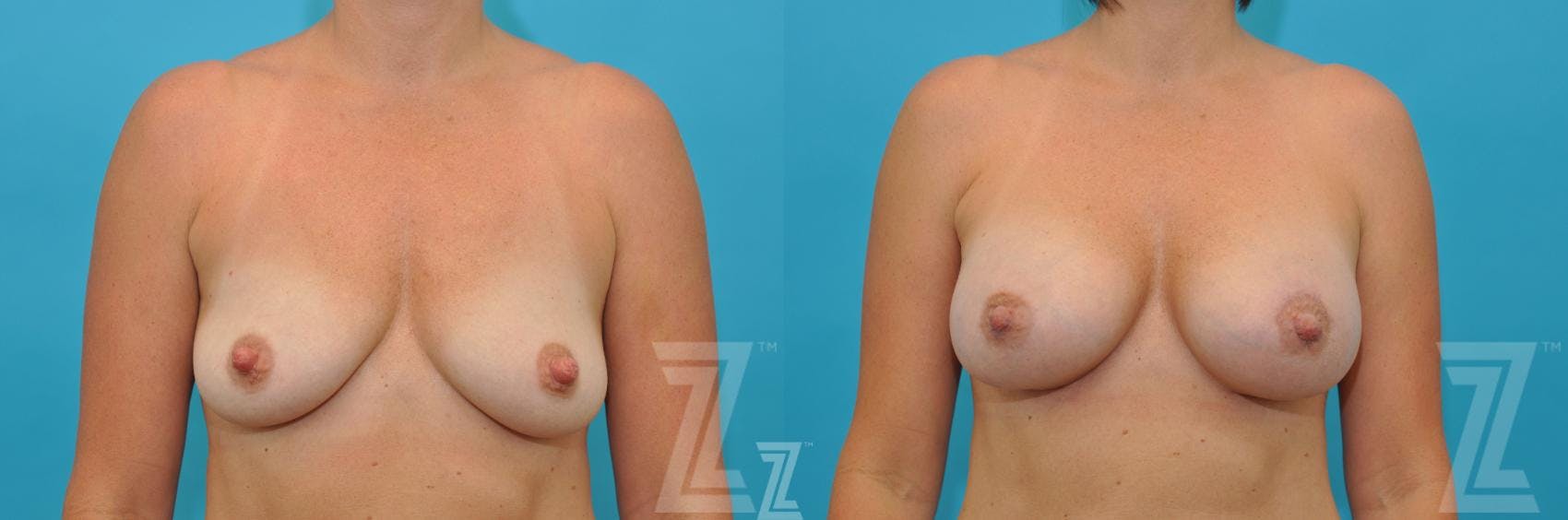 Nipple Reduction Before & After Gallery - Patient 132886786 - Image 2