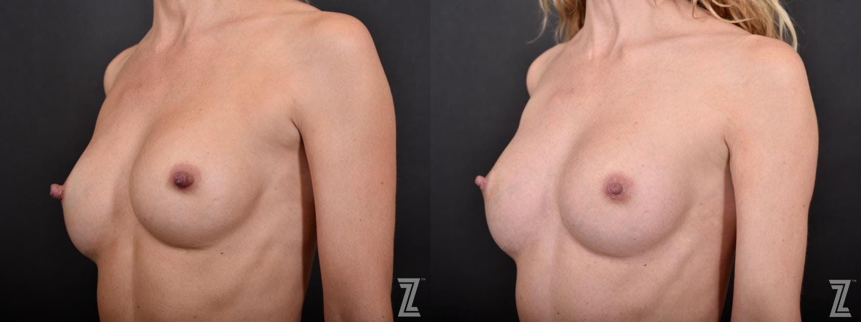 Nipple Reduction Before & After Gallery - Patient 132886788 - Image 2