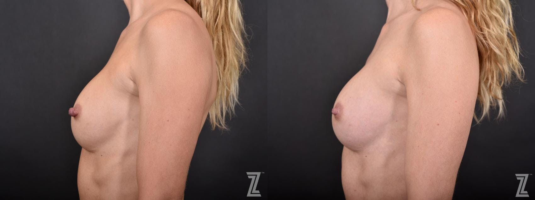 Nipple Reduction Before & After Gallery - Patient 132886788 - Image 3
