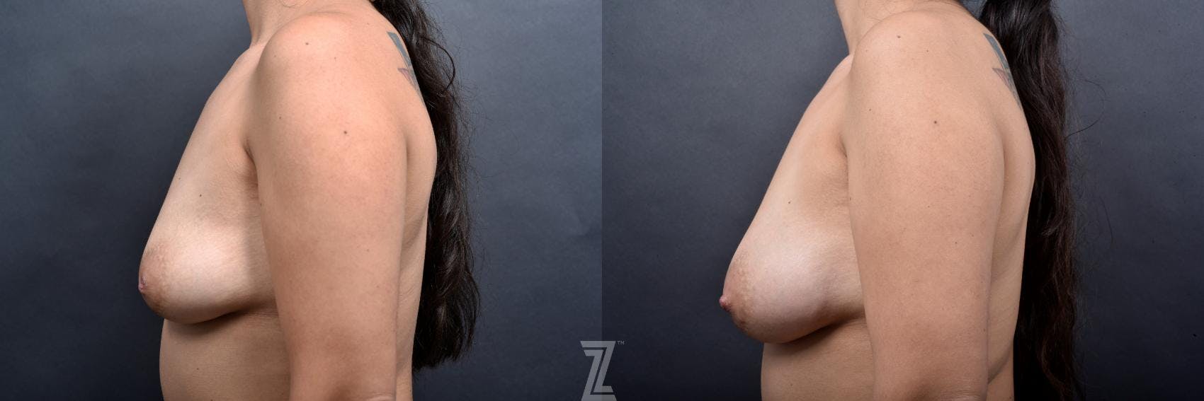 Inverted Nipple Correction Before & After Gallery - Patient 132886790 - Image 3