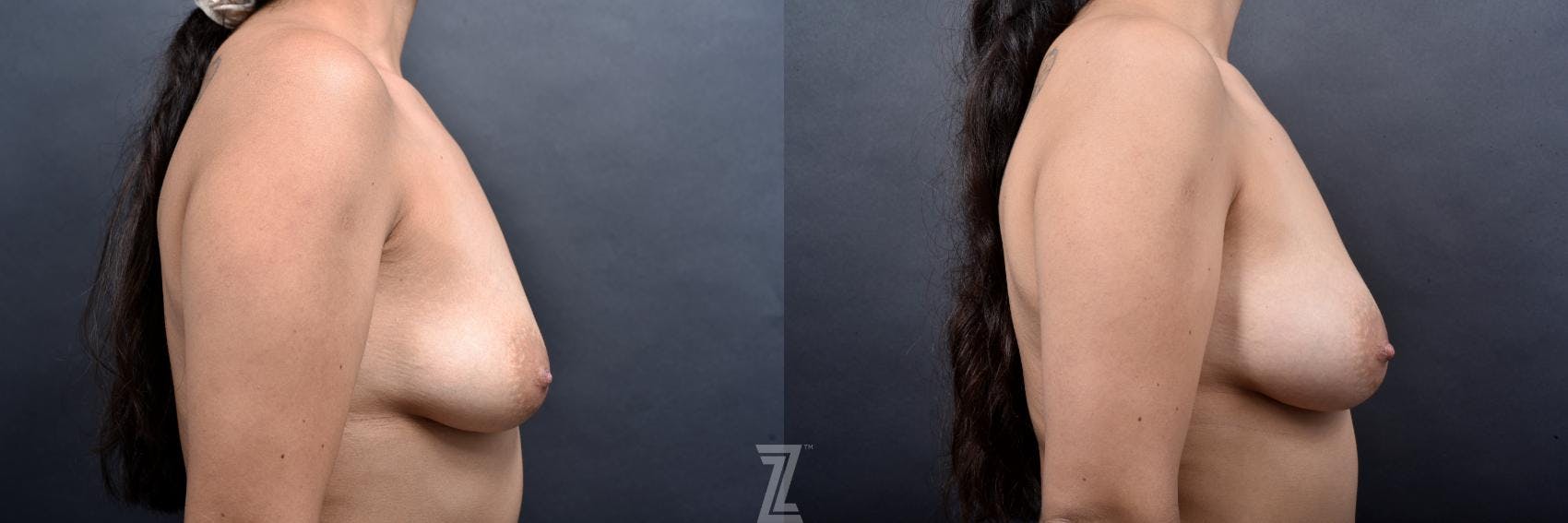 Inverted Nipple Correction Before & After Gallery - Patient 132886790 - Image 5